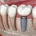 Are There Stages When It Comes To Dental Implants In Miami? 